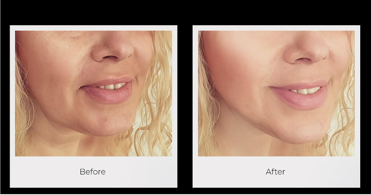HIFU Facelift in Southampton